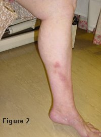 "Phlebitis" of varicose veins