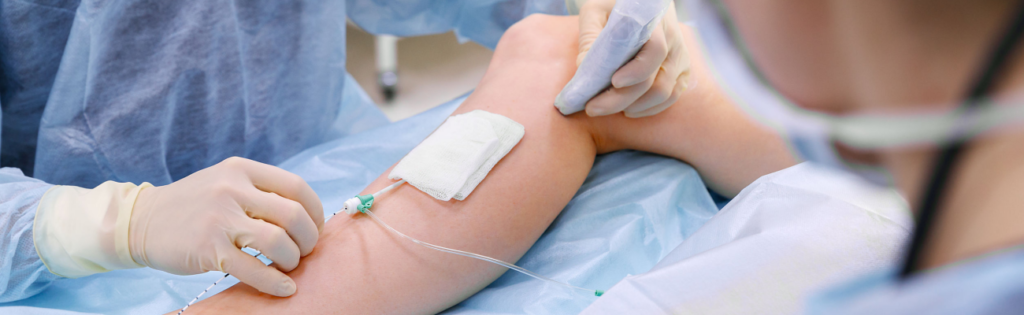 ultrasound for varicose veins